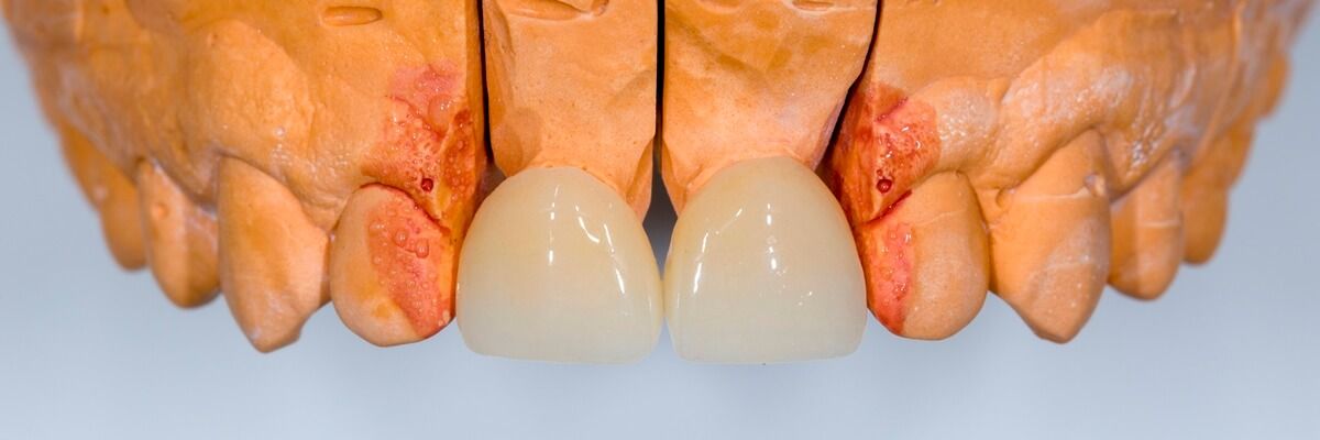 коронки для протезирования передних зубов