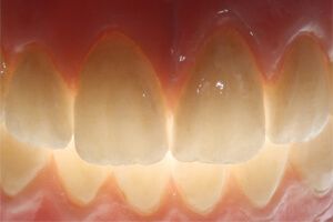зубы запротезированные керамическими коронками