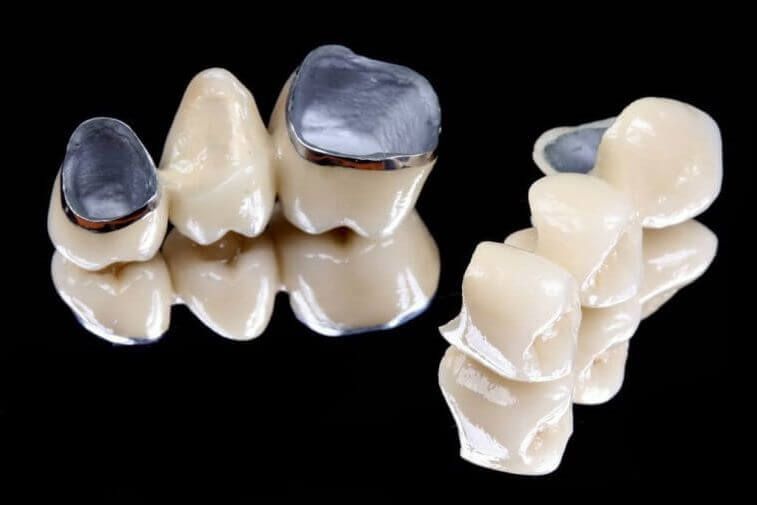 протезирование зубов металлокерамическими коронками