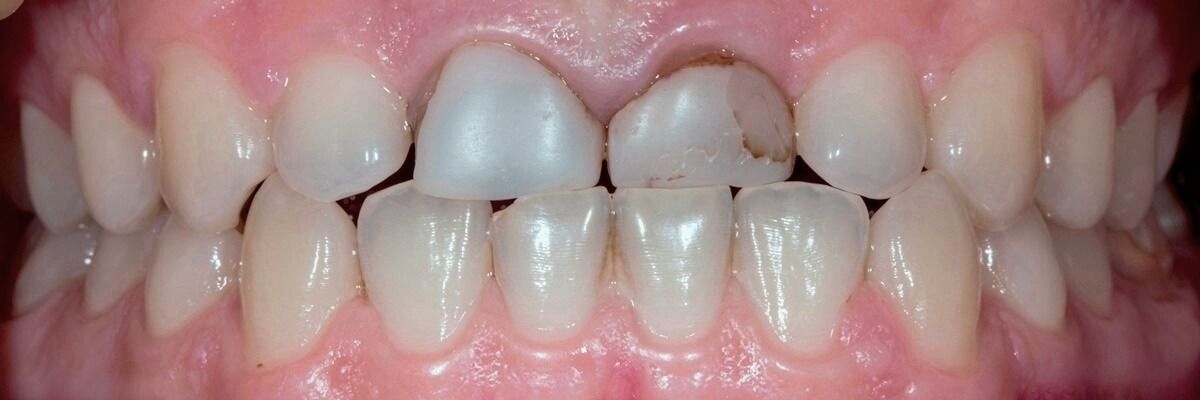 передние зубы требующие протезирование