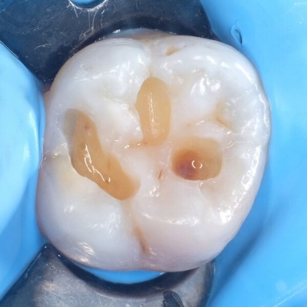 удалены пораженные кариесом ткани зуба