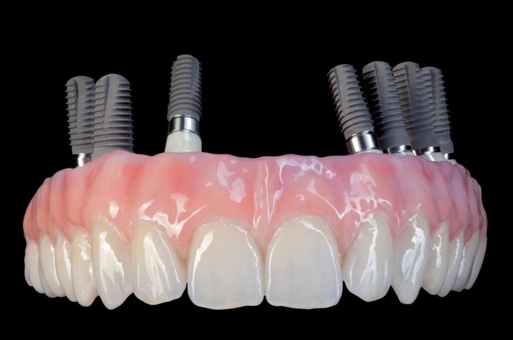 зубной протез "все на 6 | All-on-6" с имплантатами