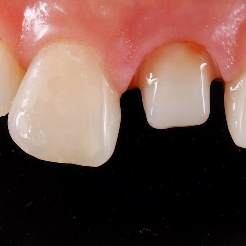 зуб подготовлен к протезированию