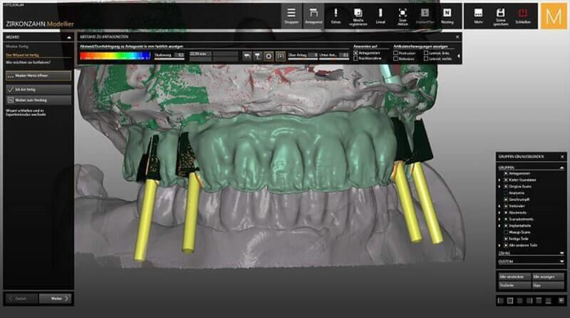 моделирование протезов двух челюстей на виртуальном артикуляторе