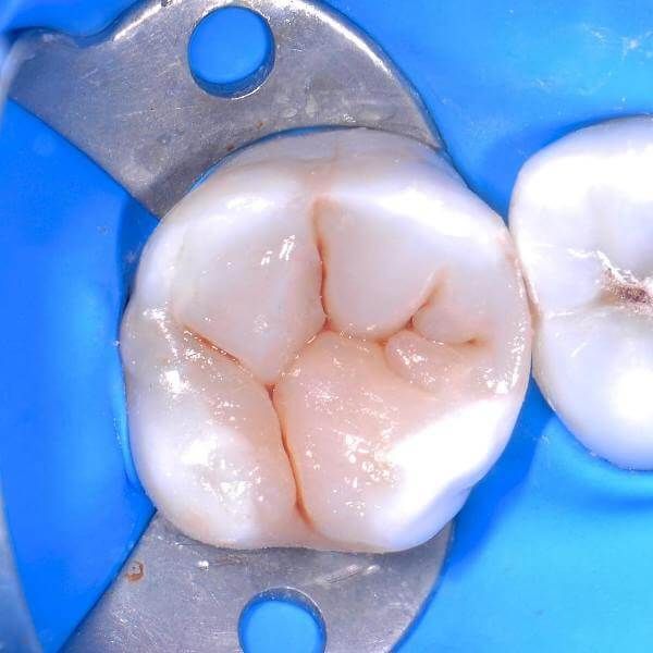вылеченный кариес под пломбой на жевательном зубе