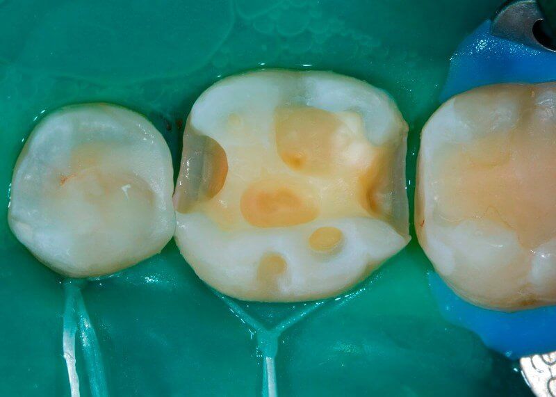 зуб после удаления кариозных тканей