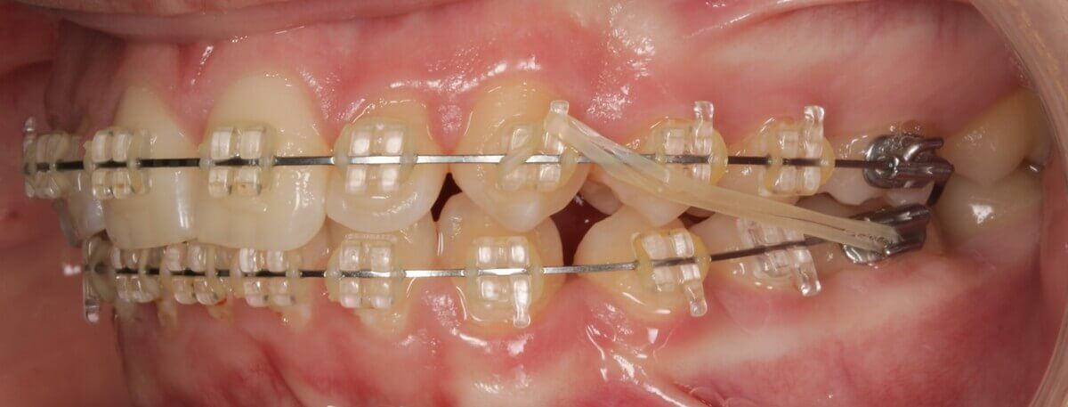 коррекция зубного ряда