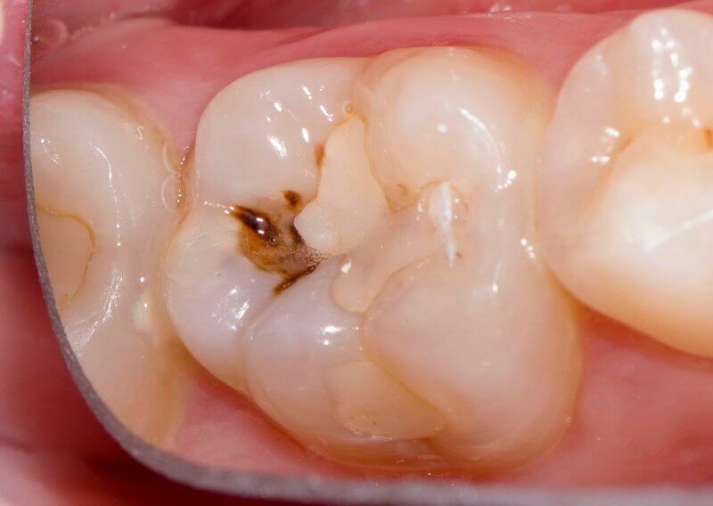 зуб с видимым отслоением старой пломбы и кариесом