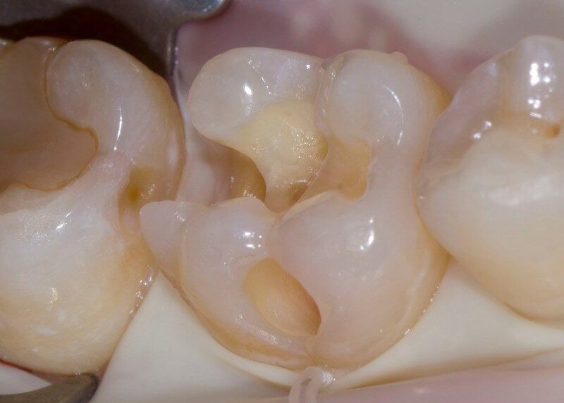 зуб после удаления кариозных тканей