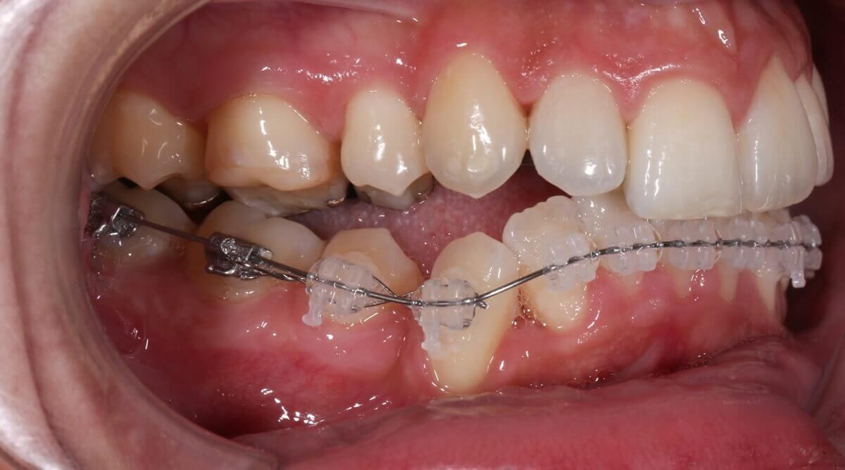 коррекция зубного ряда
