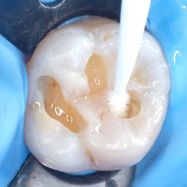наполнение полости зуба композитным материалом