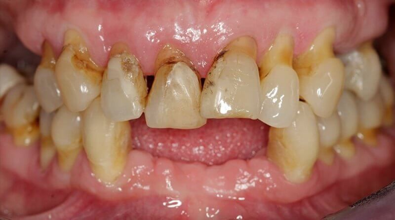 верхняя и  нижняя челюсти до протезирования зубов