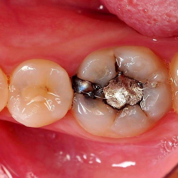 зуб с кариесом под пломбой