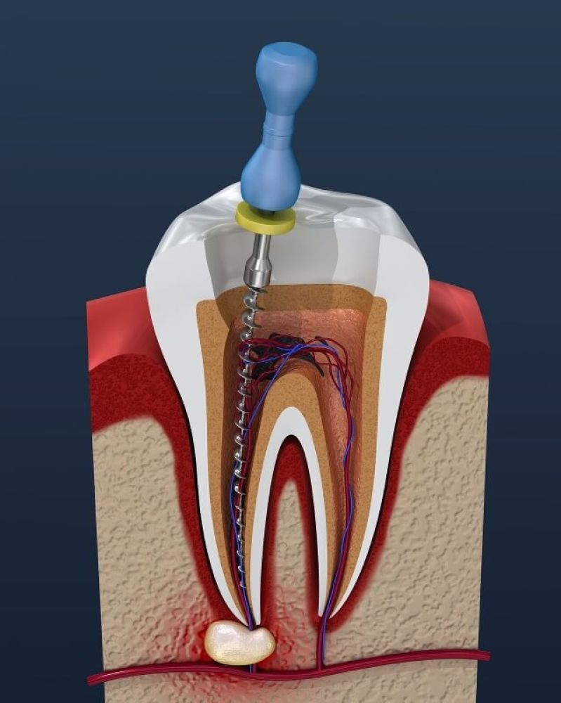 Схематичное отображение лечения каналов зуба