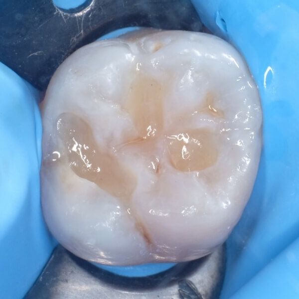 завершающий этап лечения кариеса жевательного зуба