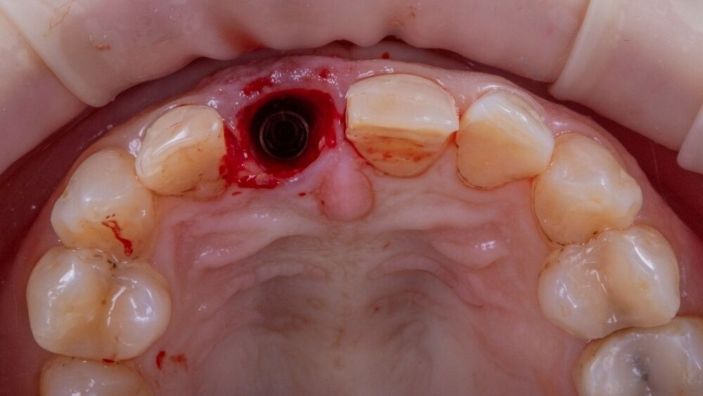 имплантат установленный вместо переднего зуба