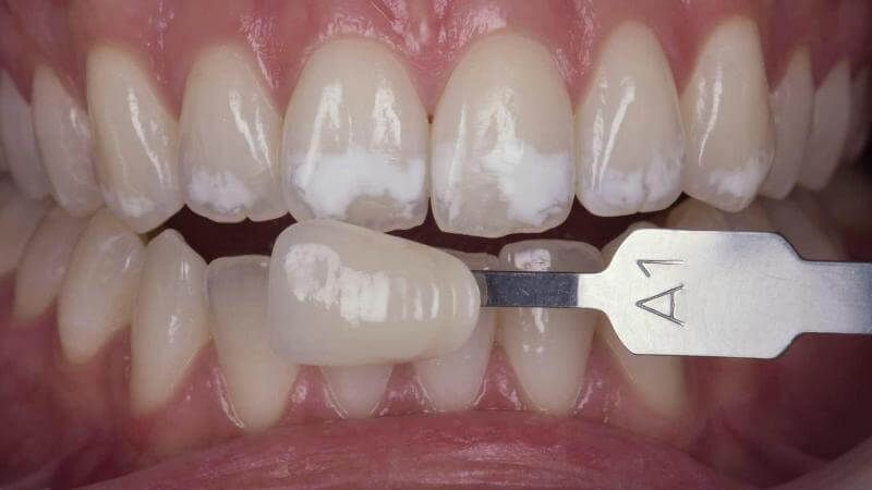 пятна на эмали исправляются установкой виниров на зубы