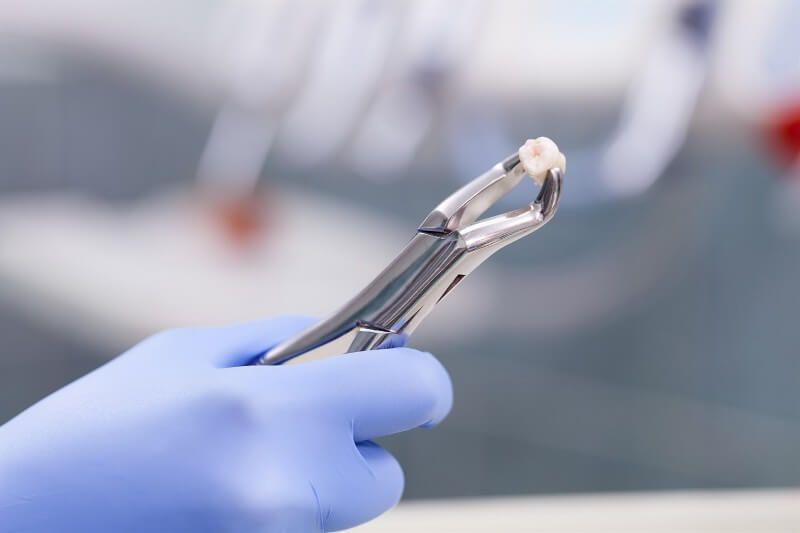 атравматичное удаление зуба для последующей имплантации