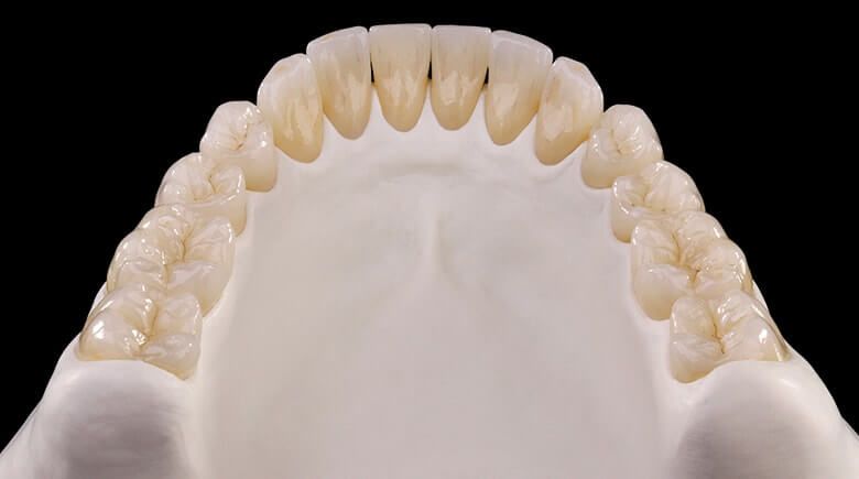 протезирование зубов нижней челюсти циркониевыми коронками