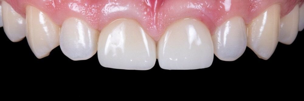 передние зубы после протезирования