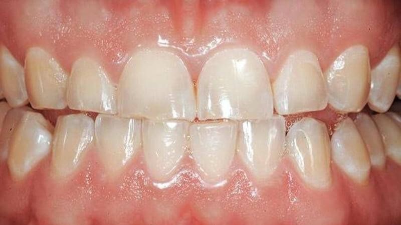 стираемость зубов исправляется установкой виниров на зубы