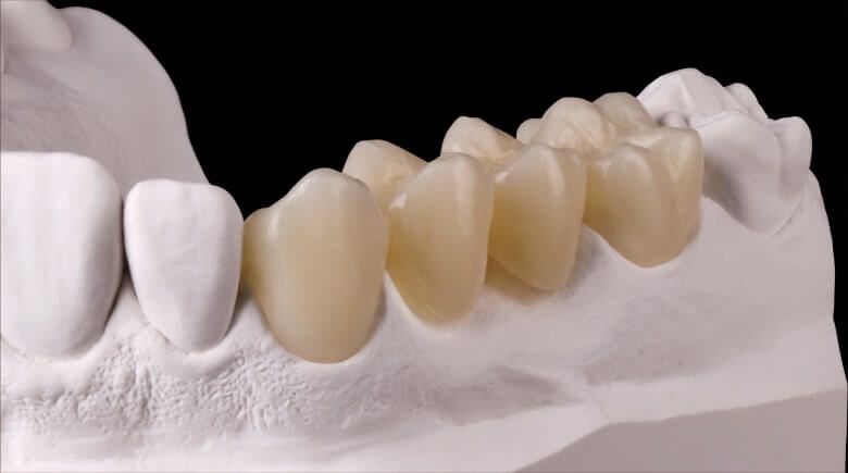 коронки из диоксида циркония на жевательные зубы