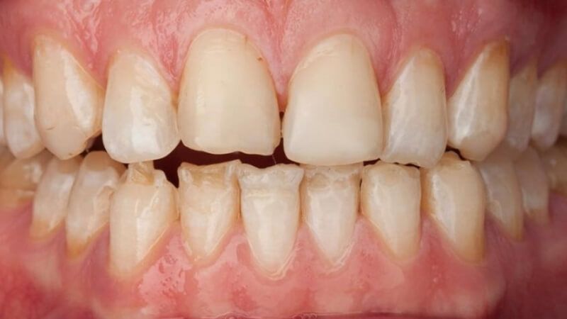 недостатки эмали исправляются установкой виниров на зубы