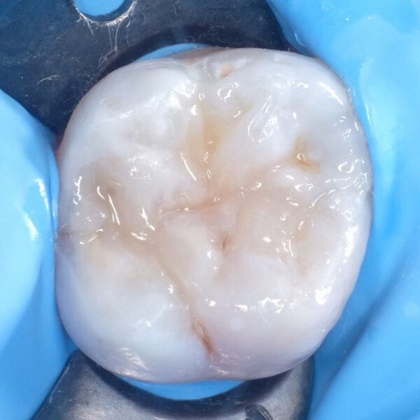 жевательный зуб после лечения кариеса фиссур