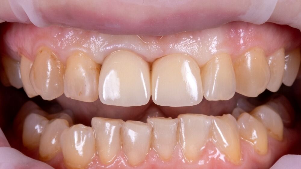 передние зубы после фиксации коронок