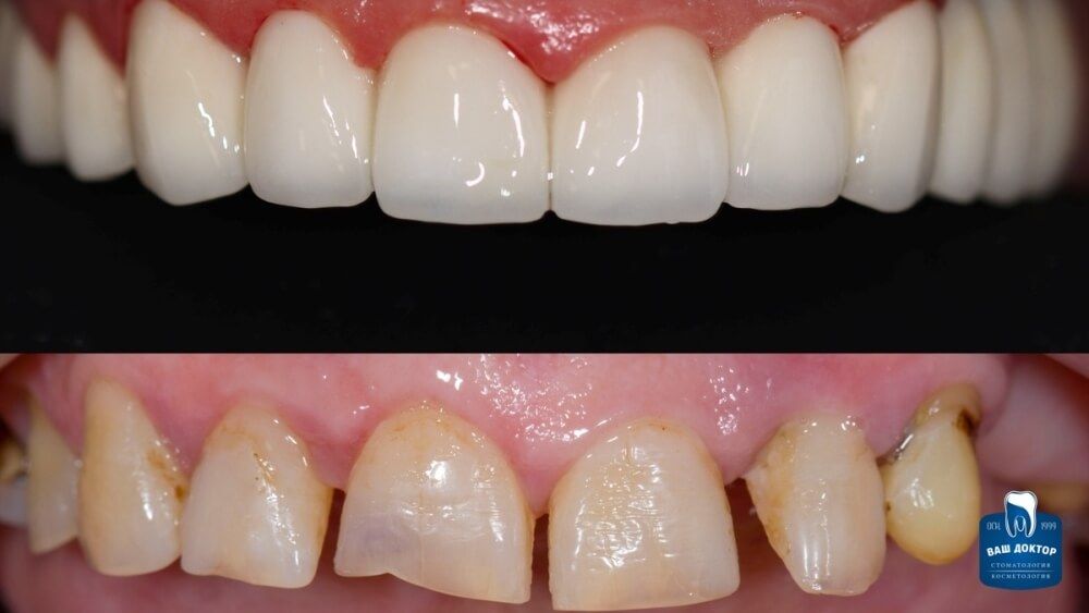 до и сразу после протезирования зубов циркониевыми коронками