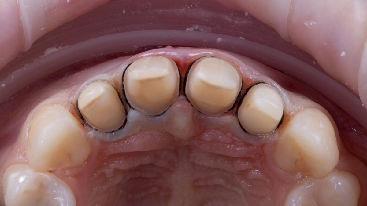 передние зубы с минимальной обработкой