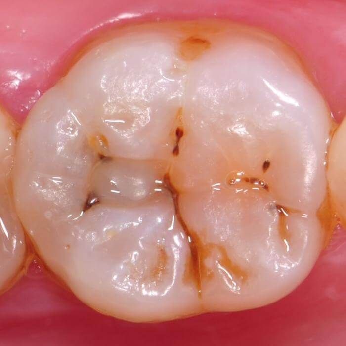 жевательный зуб с небольшим кариесом под пломбой