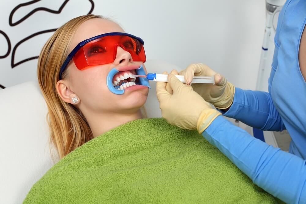 нанесение специального геля на поверхность зубов