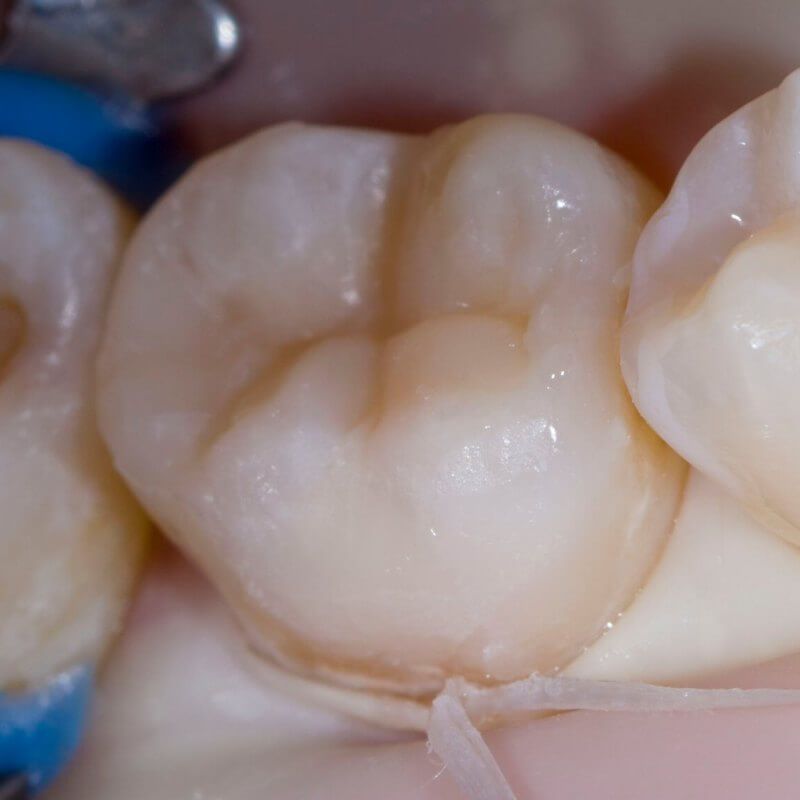 зуб после лечения кариеса