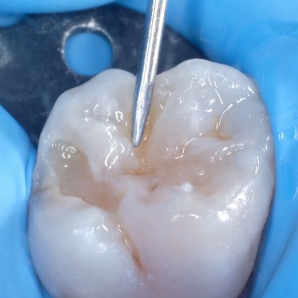 формирование бугров жевательного зуба после лечения кариеса