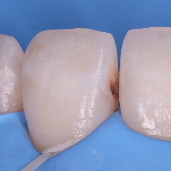 изолированный зуб с кариесом