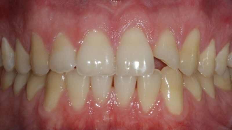 сколы эмали зубов исправляются установкой виниров на зубы