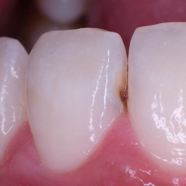 обнаруженный кариес между зубами