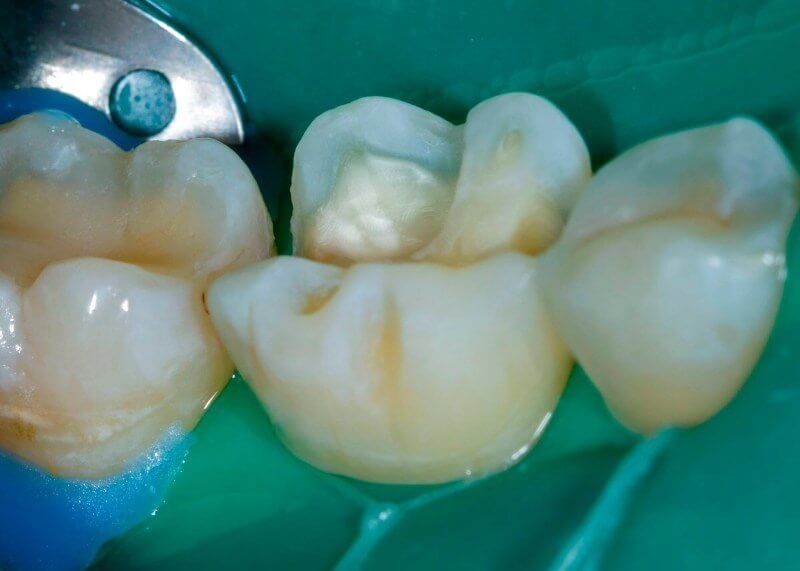 зуб подготовленный к нанесению жидкого композита