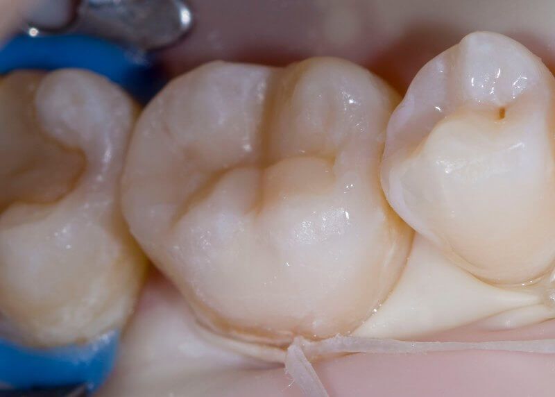 зуб после установки пломбы
