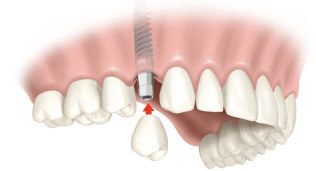 3D модель верхних зубов с имплантом