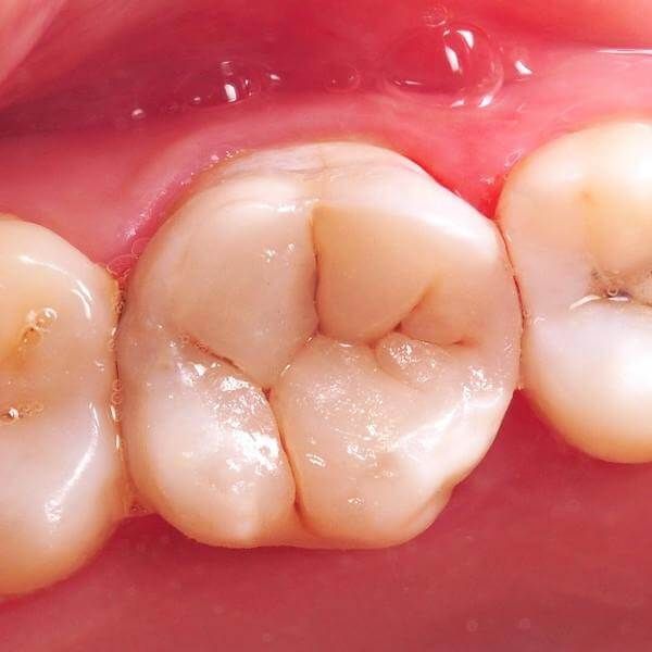 зуб после лечения кариеса под пломбой