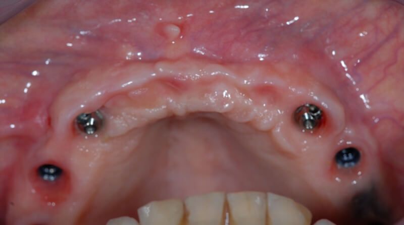 4 импланта для крепления зубного ряда "все на 4 | all-on-4"