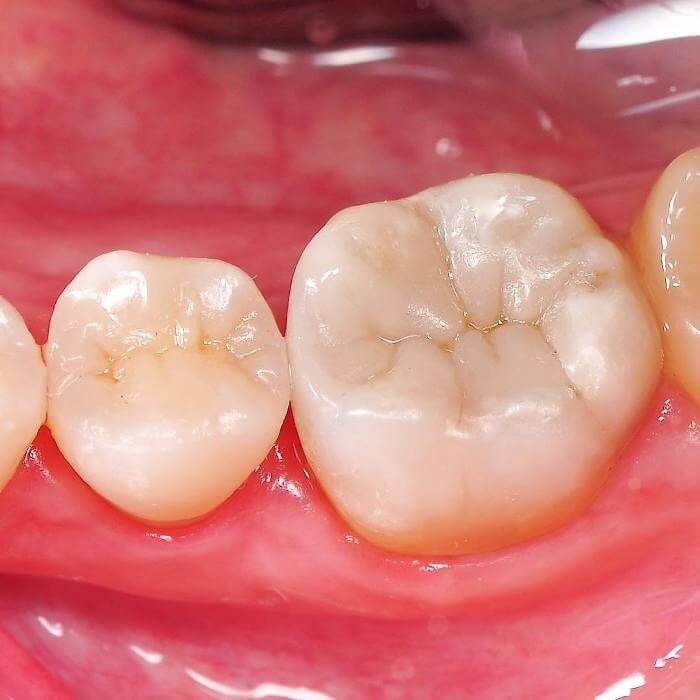 зуб с вылеченным кариесом под пломбой