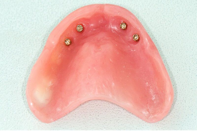 зубной протез с креплением на имплантатах