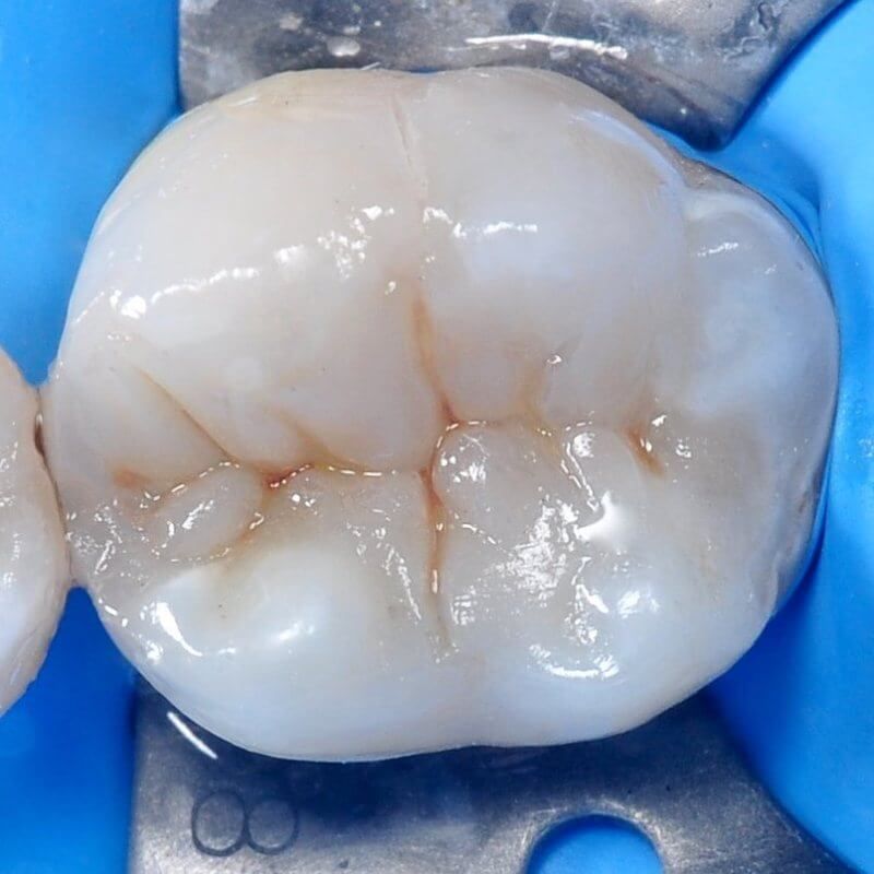 здоровый зуб после замены старой пломбы