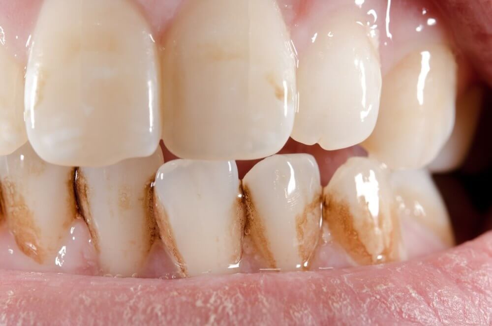 Смещение передних нижних зубов под давлением восьмерки