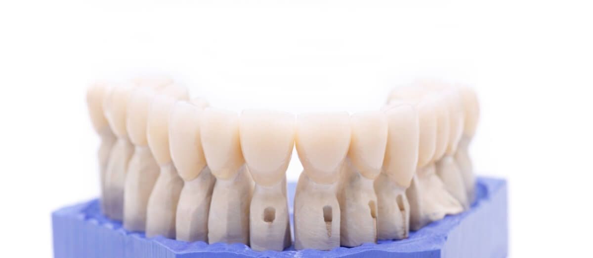 восстановление (протезирование) зубов циркониевыми коронками