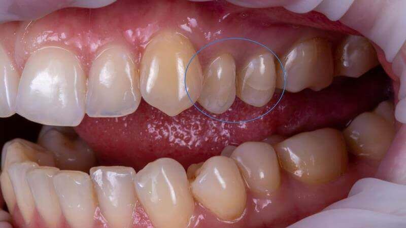 Два зуба после эндодонтического лечения с небольшим количеством сохранившейся эмали