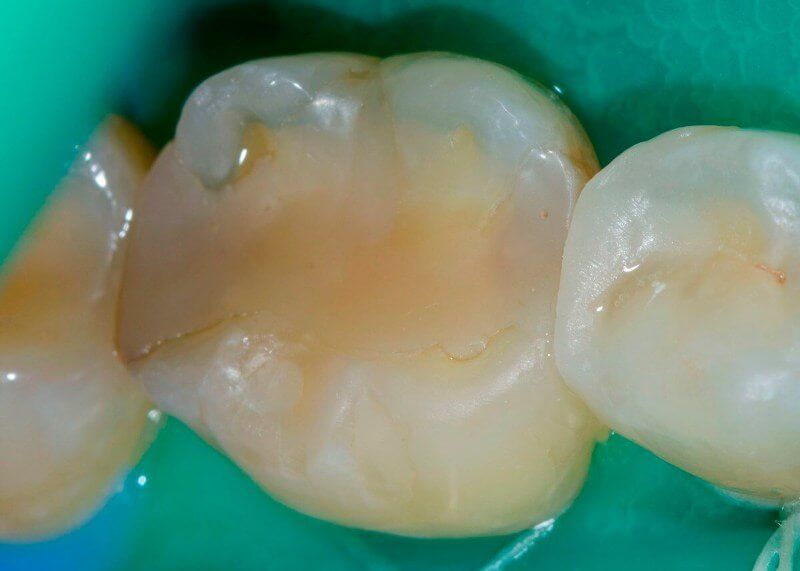исходное состояние зуба до лечения кариеса